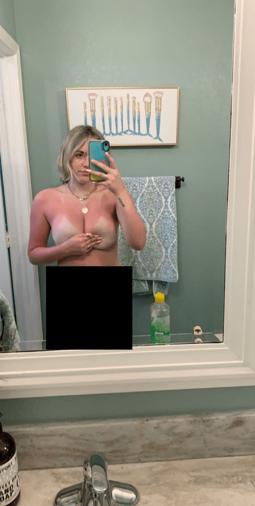 Got a little sunburntðŸ˜‚