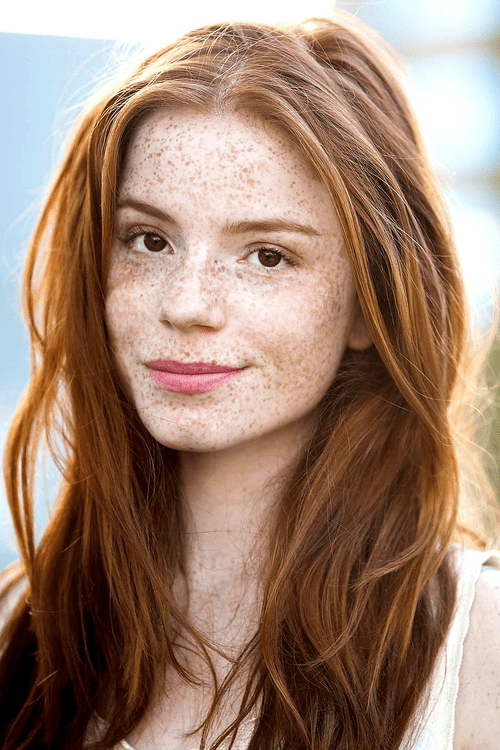 Freckles